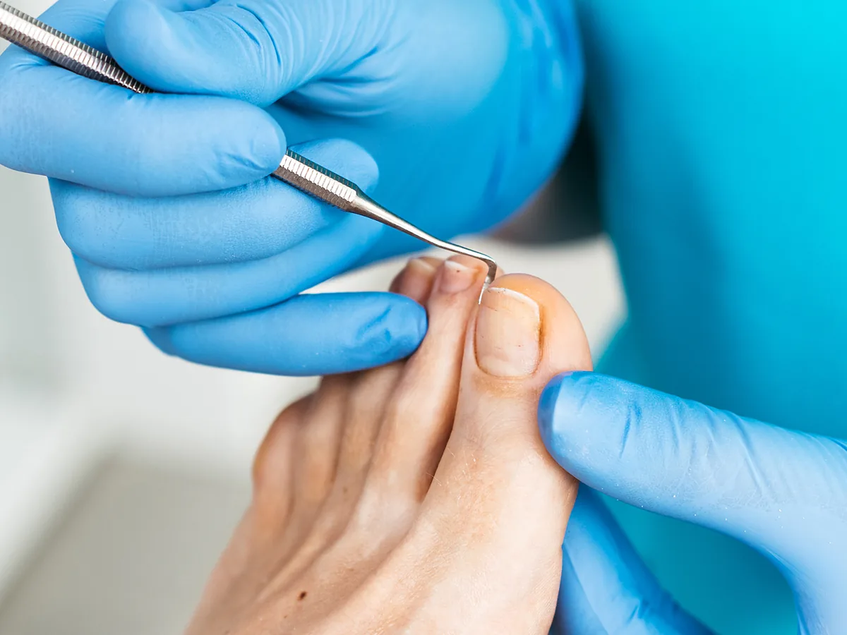 Podolog FootMedica w rękawiczkach pracuje przy paznokciu palucha pacjenta