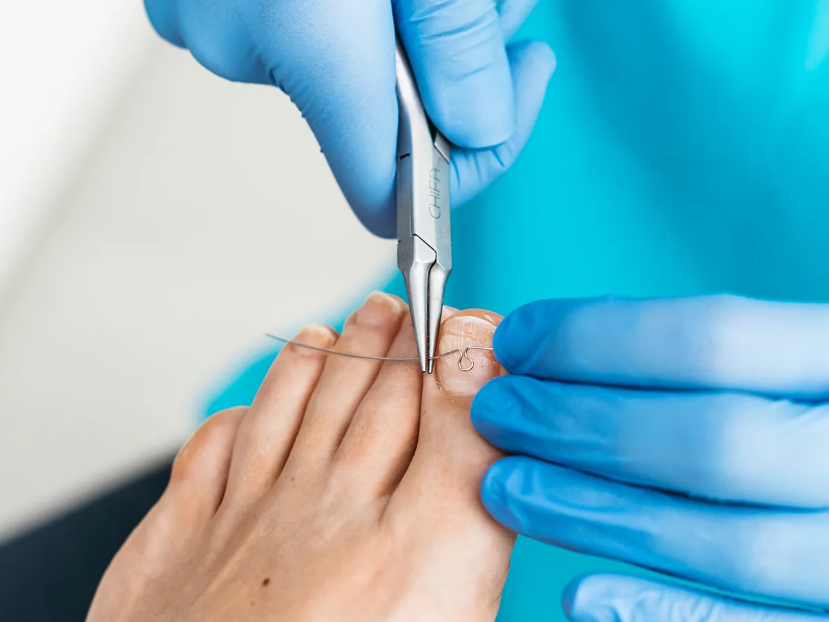 Podolog FootMedica układa pęsetą drut klamry na paznokciu palucha