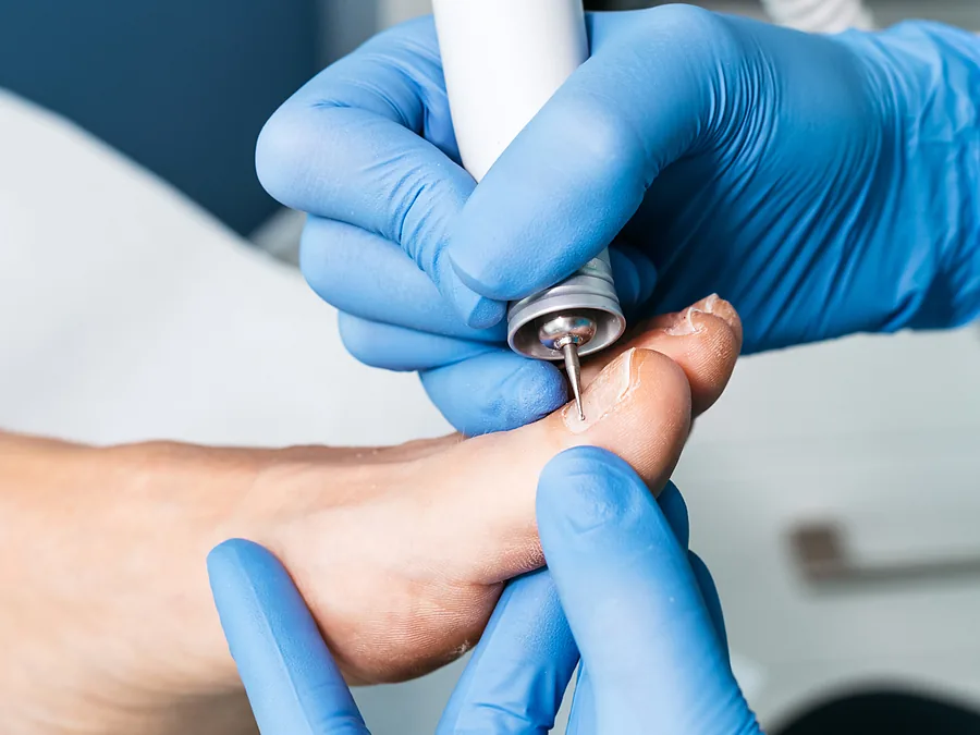 Oczyszczanie płytki paznokcia frezarką w gabinecie FootMedica
