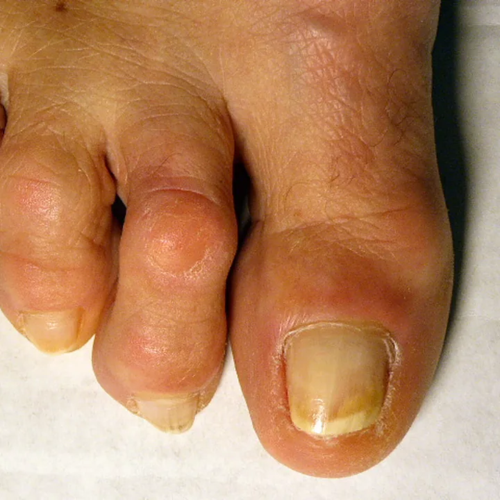 Po terapii laserem Lunula: Paznokieć palucha zmieniony przez grzybicę
